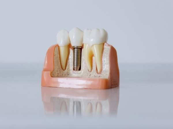 Dental-Implants